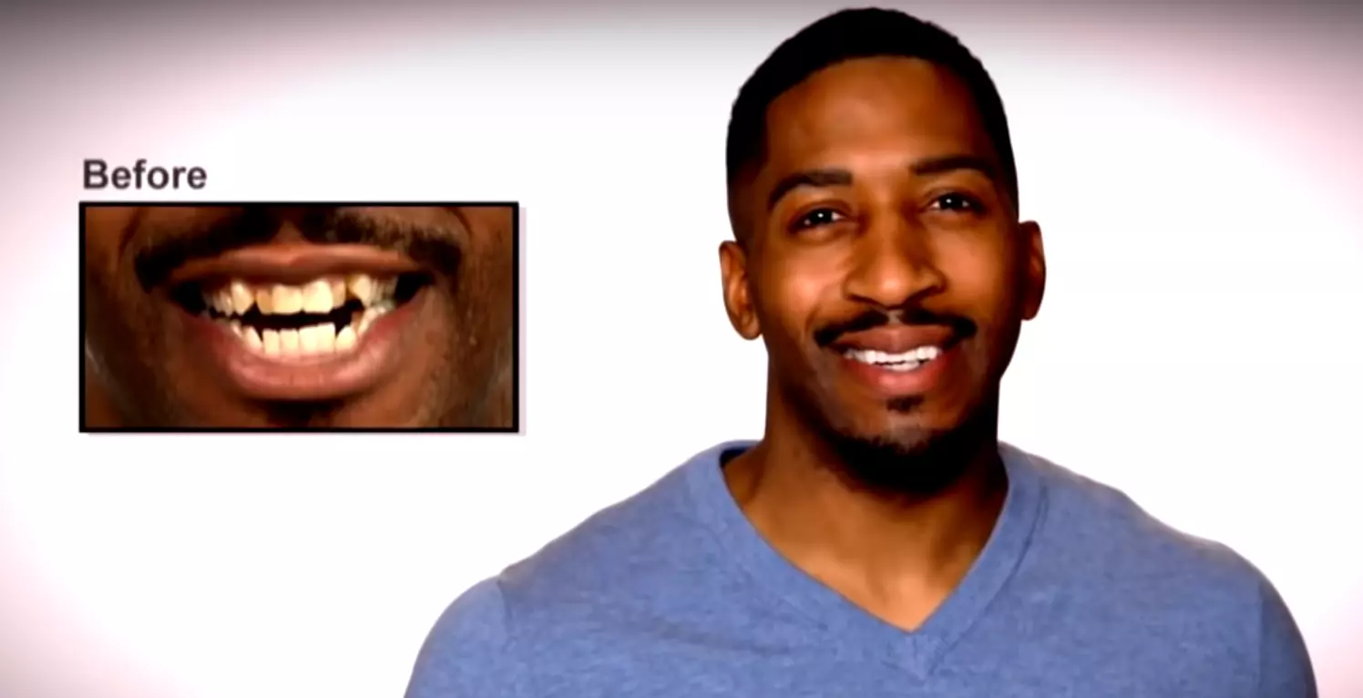 Perfect Smile виниры