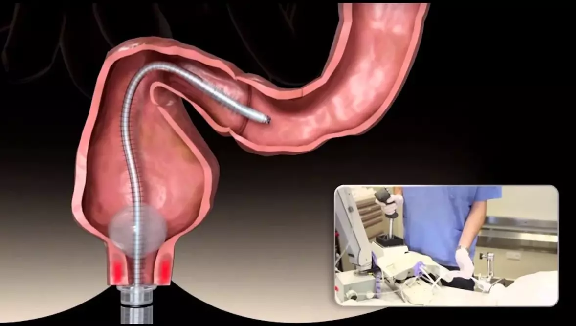 Какой способ колоноскопии выбрать: под наркозом или нет
